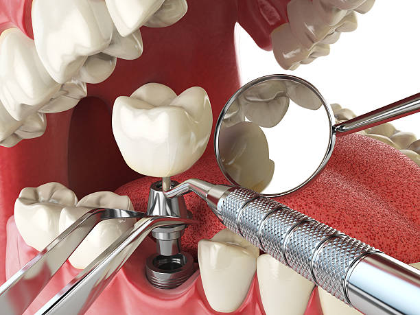 Best Emergency Root Canal Treatment in Youngstown, NY